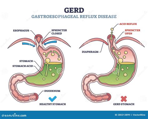 diseases that are similar to gerd but more severe